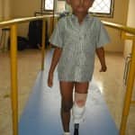 Jorge receives his first prosthesis at age 6